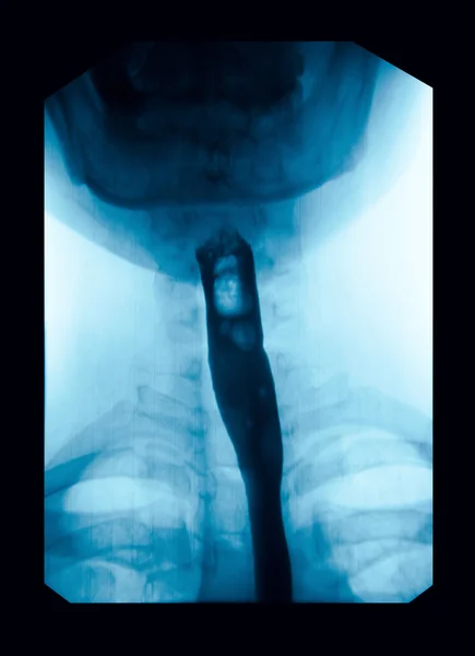De afbeelding van x-ray bovenste gastro-intestinale (ugi), esophagram. — Stockfoto