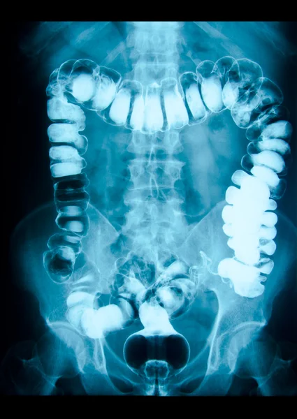 Intestinale abdominale xray — Stockfoto