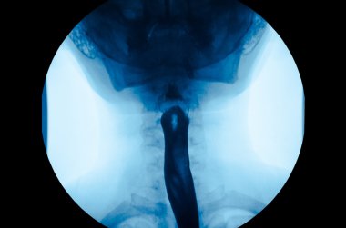 x-ışını üst gastrointestinal uci, esophagram resim.