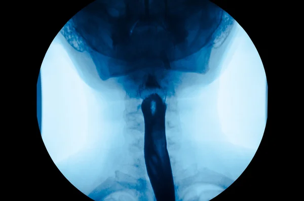 X 線上部消化管ウギ、esophagram の画像. — ストック写真