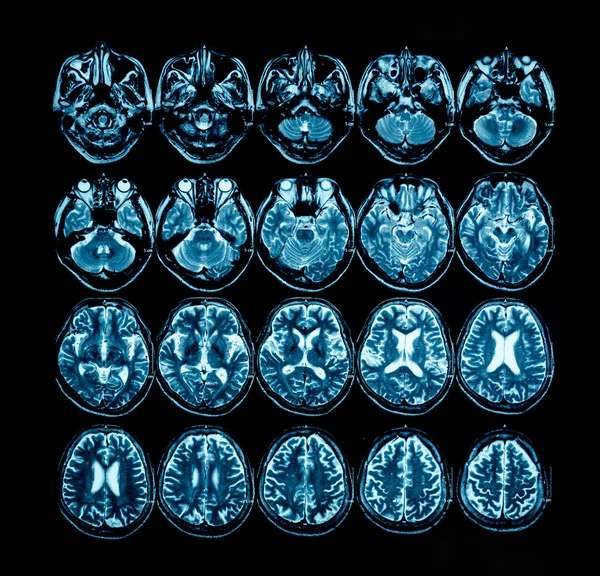 Filme de raios-X da tomografia computadorizada cerebral — Fotografia de Stock