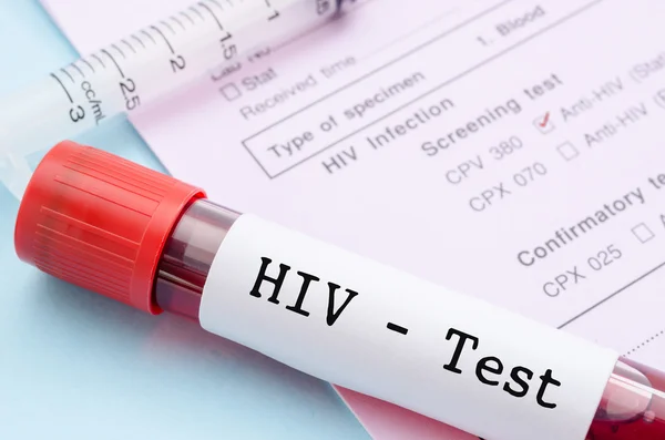 Vzorek krve kolekce trubice s popiskem testu Hiv — Stock fotografie