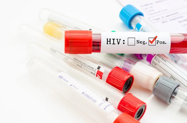 Пробирка для сбора крови с тестом на ВИЧ . — стоковое фото