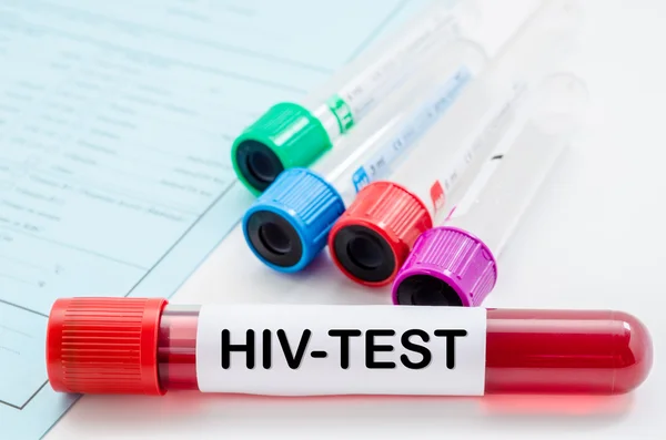 Blodprov för Hiv-test. — Stockfoto