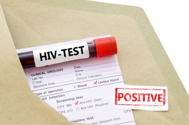 Kan örneği ile HIV testi pozitif.