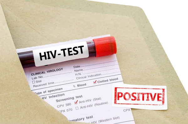 Próbki krwi z pozytywny test na Hiv. — Zdjęcie stockowe