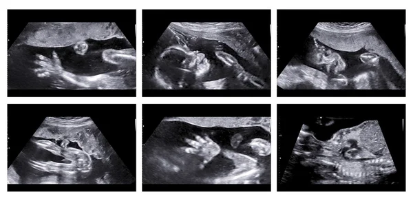 Colagem de imagens médicas de ultra-som varredura anomalia em uma fêmea — Fotografia de Stock