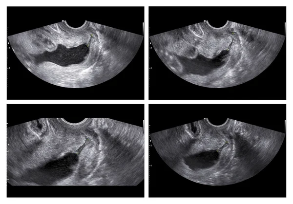 Collage de imágenes médicas de ultrasonido durante la exploración de anomalías muestran — Foto de Stock