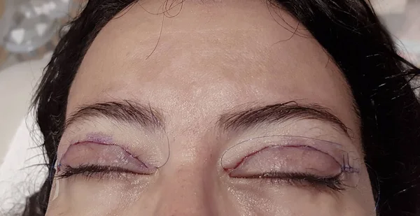 eyelid surgery -stitches on the eyelid immediately after surgery