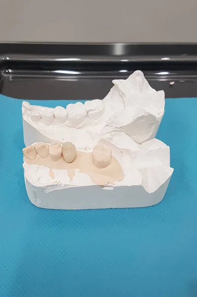 Modelde dişsel zirkon seramik kaplamalar