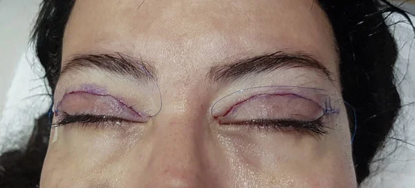 eyelid surgery -stitches on the eyelid immediately after surgery