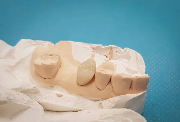模型上的牙科锆石陶瓷冠 — 图库照片