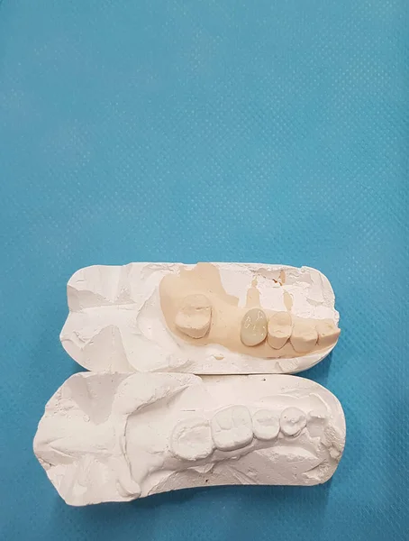 模型上的牙科锆石陶瓷冠 — 图库照片
