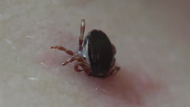 Hard Bodied Tick Mite Sits Skin Person Dug Its Head — ストック動画