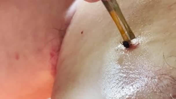 Krankenhaus Eine Enzephalitis Milbe Sitzt Auf Der Haut Eines Menschen — Stockvideo