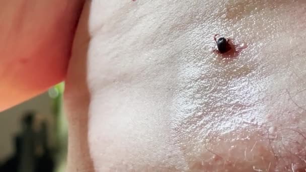 Insect Removal Operation Tweezers Hospital Encephalitis Mite Sits Skin Person — Video