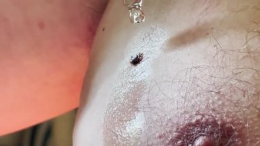 İnsan derisini kazıp kan emen kene, tıbbi pipetten dezenfekte için düşer. Hastane