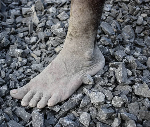 Left Leg of a workman in west bengal India