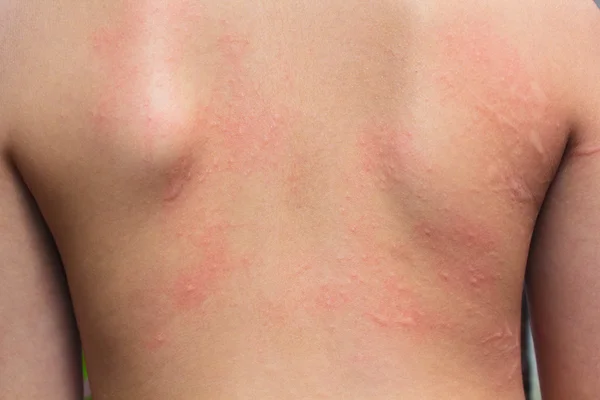 アレルギーの発疹. ストック写真
