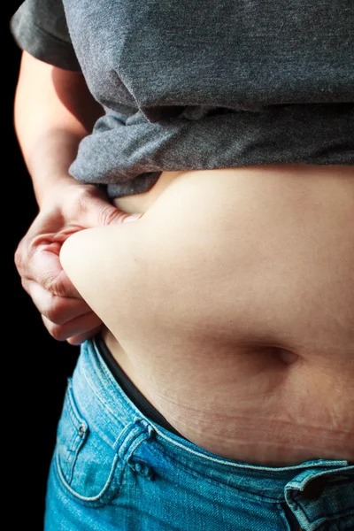 Extremely obese womans belly. — Stock Photo, Image