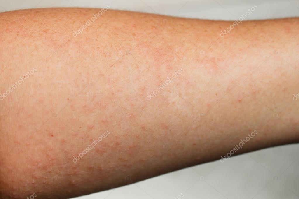 utslag allergisk reaktion