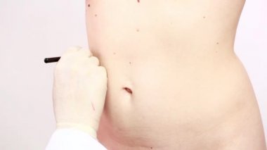 Cerrah kadın Liposuction cerrahi için hazırlanıyor
