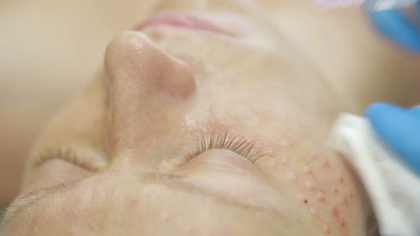 Cosmetische behandeling met een injectie in een kliniek. verrijking van de huid — Stockvideo