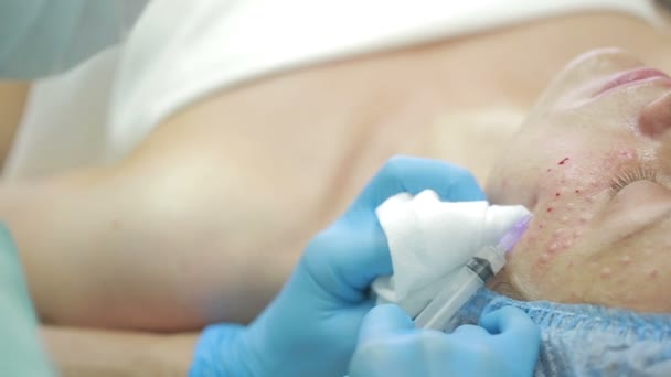 Cosmetische behandeling met een injectie in een kliniek. verrijking van de huid — Stockvideo