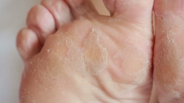 Female feet with skin peeling off. foot scrub after the procedure — Stock Video