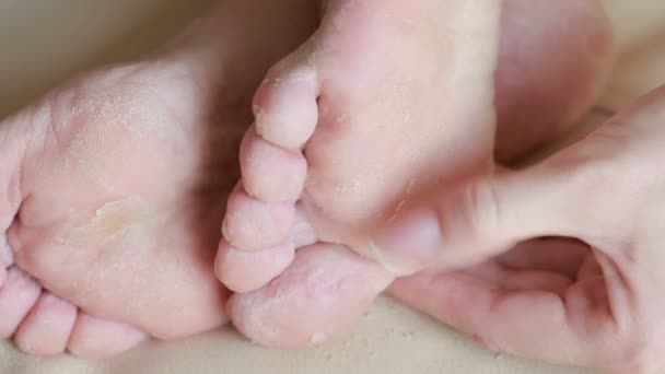 Pies femeninos con la piel despegando. exfoliación del pie después del procedimiento — Vídeo de stock