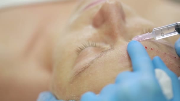 Trattamento cosmetico con iniezione in clinica. fortificazione della pelle — Video Stock