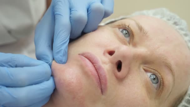 Closeup beautician menghilangkan jerawat pada wanita wajah dengan jarum — Stok Video