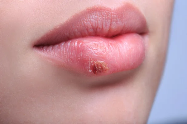 Beautiful lips virus infected herpes — Stock Photo, Image