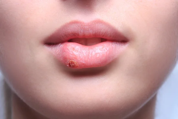 Bibir indah virus terinfeksi herpes Stok Gambar Bebas Royalti