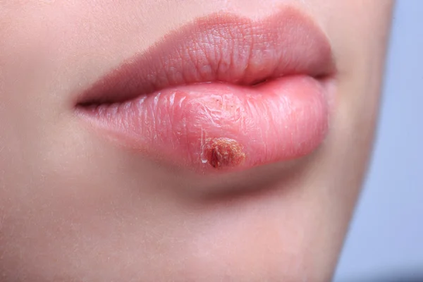 Bibir indah virus terinfeksi herpes Stok Foto Bebas Royalti
