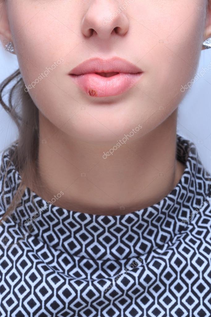 Beautiful lips virus infected herpes — Stock Photo © kopitin 62129163