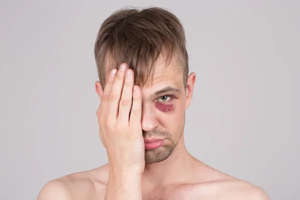 Un homme avec un œil blessé. Gros plan . — Photo