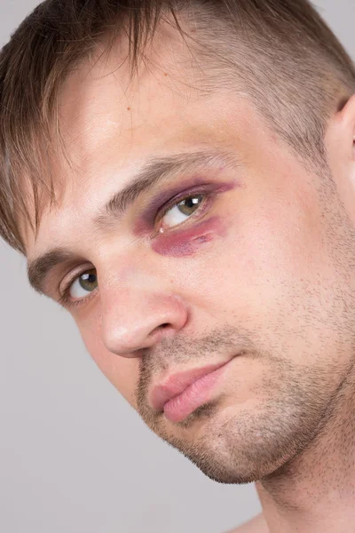 Man met een gewonde oog. Closeup. — Stockfoto