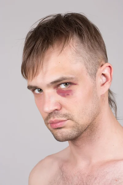 Un hombre con un ojo herido. Primer plano. . — Foto de Stock