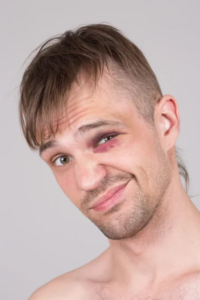 Man with an injured eye. Closeup. — Stock Photo, Image