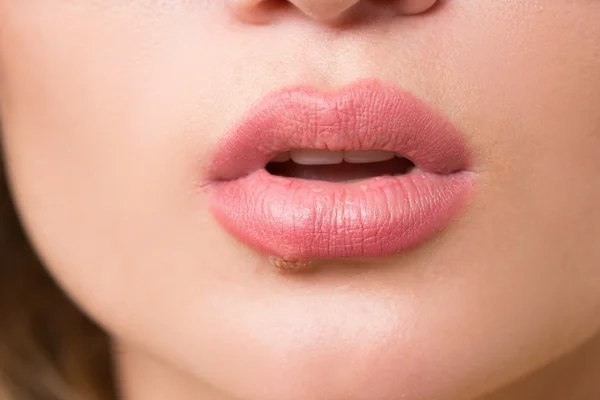 Belles lèvres virus herpès infecté — Photo