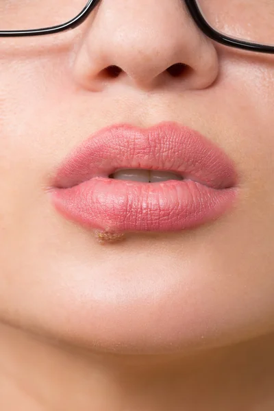 Lindos lábios vírus herpes infectado — Fotografia de Stock