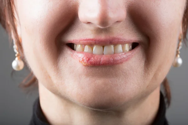 Lip infection with the herpes virus — Stock Photo, Image