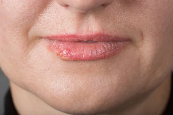 Lip infection with the herpes virus — Stock Photo, Image