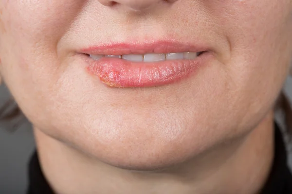 Инфекция губ вирусом герпеса — стоковое фото