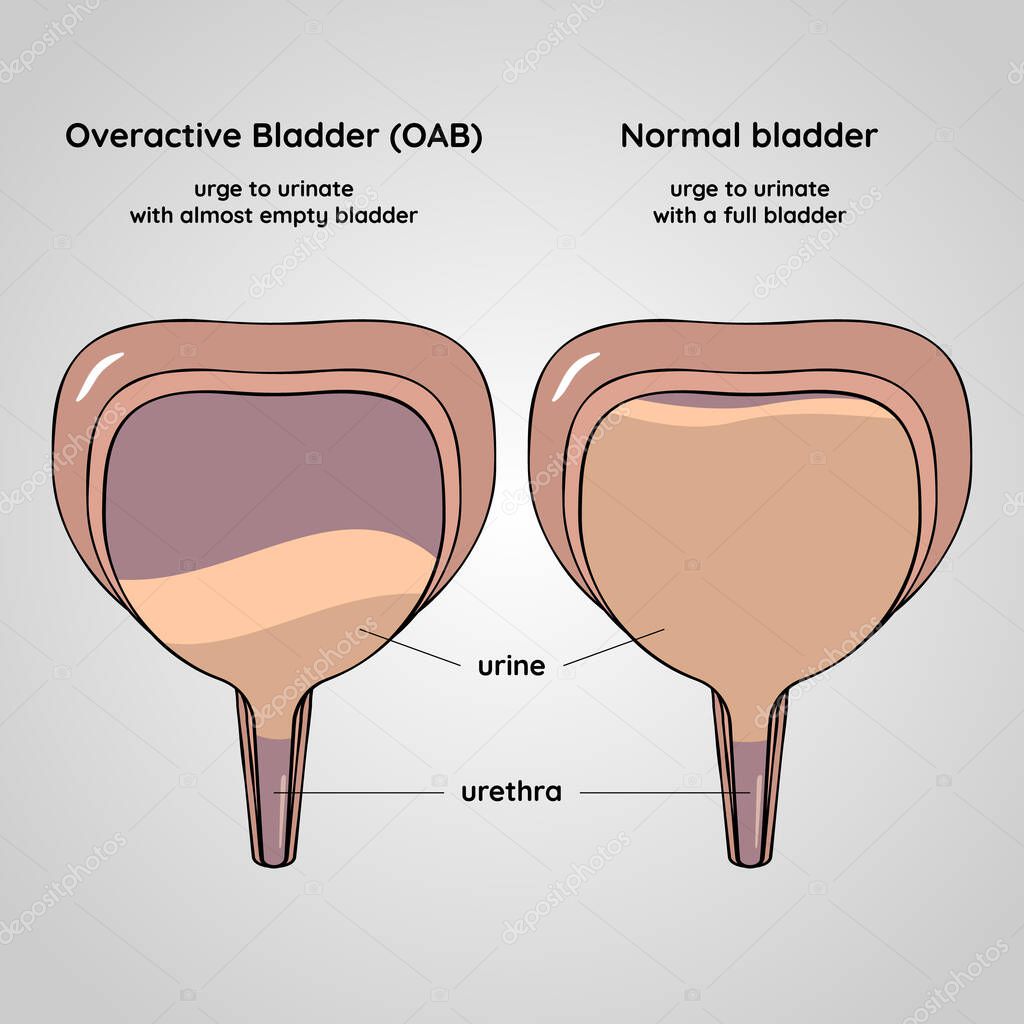 Overactive and normal bladder. Urinary system disease. Urology. Medical flat vector illustration.