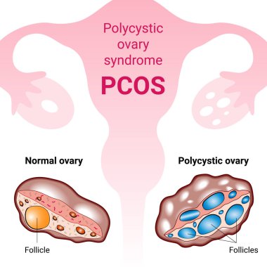 Polisistik yumurtalık sendromu PCOS, hormonal teşhis, anormal kanser üreme kistleri. Tıbbi vektör illüstrasyonu