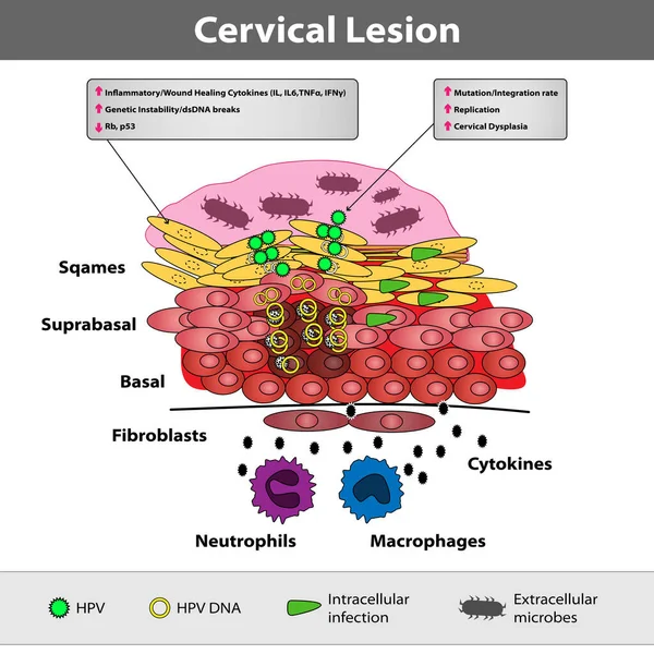 Una Lesión Cervical Precancerosa Apariencia Cervical Anormal Células Escamosas Glandulares — Vector de stock