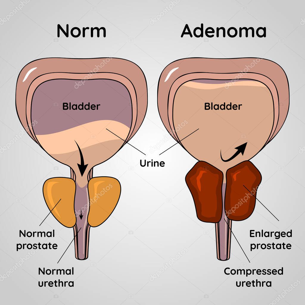 Benign prostatic hyperplasia. Normal bladder and BPH problem. Pain in male reproductive system concept. Human internal organs, prostate gland, bladder anatomy, prostate adenoma medical vector illustration