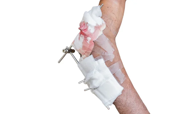 Right arm of a male has been injured on white — Stock Photo, Image